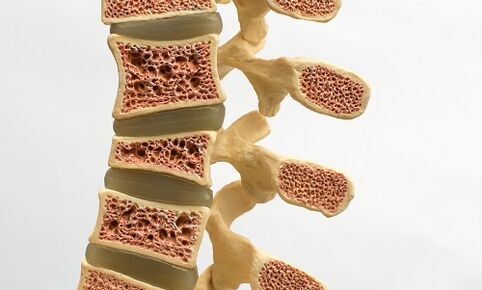 Osteoporoos on üks alaseljavalu põhjusi