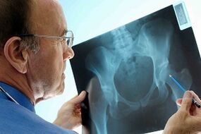 Puusaliigese artroos X -RAY -l