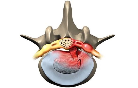 osteokondroosist kahjustatud selgroolüli